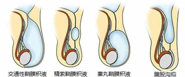 啥是腹股沟疝气,什么是腹股沟疝气有什么症状