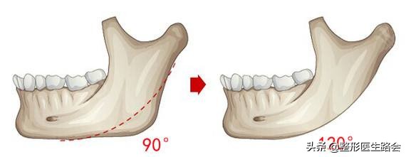 好看的脸型下颌角,120度的下颚角什么样