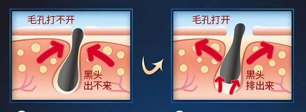 黑头闭口连根拔起,黑头粉刺连根拔起留坑