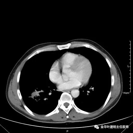 伴有脑转移了的肺癌能手术吗？