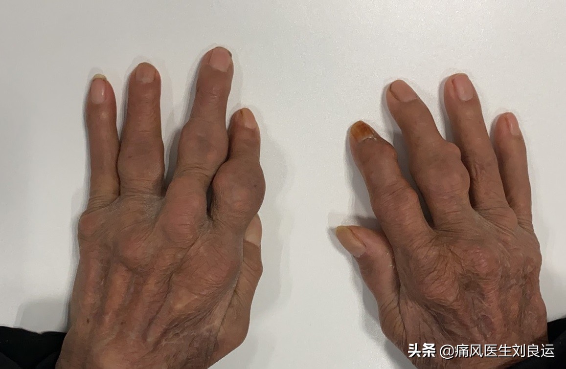 降尿酸可以使痛风结晶溶解吗,吃药降尿酸会损坏肾功能吗