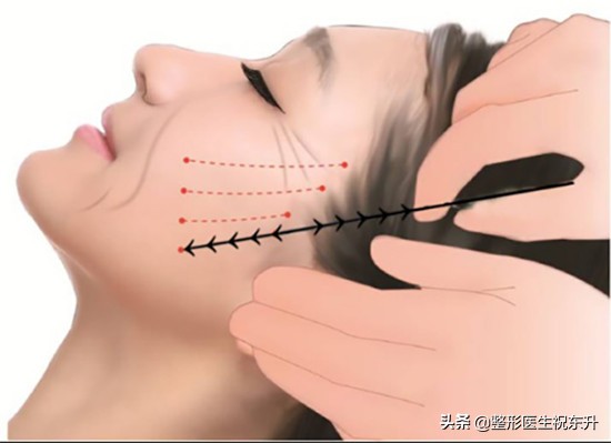 30岁脸部松垮下垂要做拉皮吗,35岁面部松弛怎么办