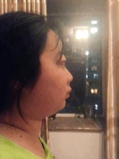 格林巴利综合征肌无力咋恢复,瘫痪的人怎么站起来