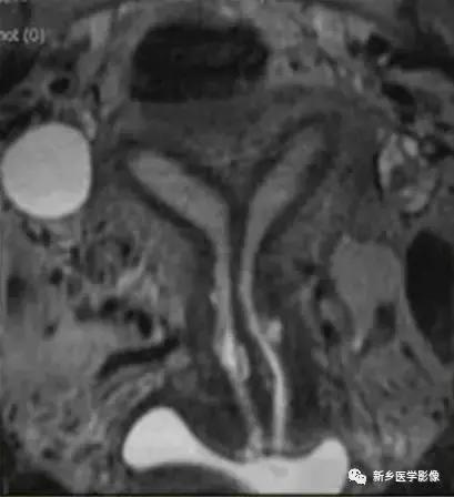 子宫发育异常,应想到的6大类常见畸形