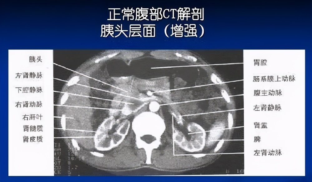 早期易忽视，发现即晚期，治疗效果差，胰腺癌为什么这么难？