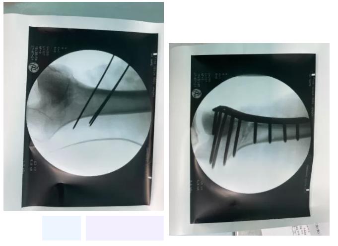 长短腿骨盆倾斜,二郎腿骨盆纠正