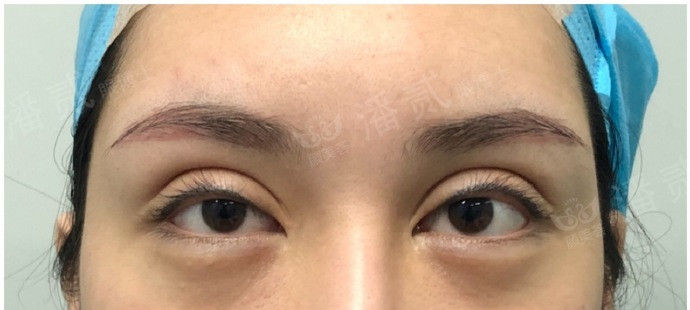 全切双眼皮提肌失败还能修复吗,什么是失败的双眼皮