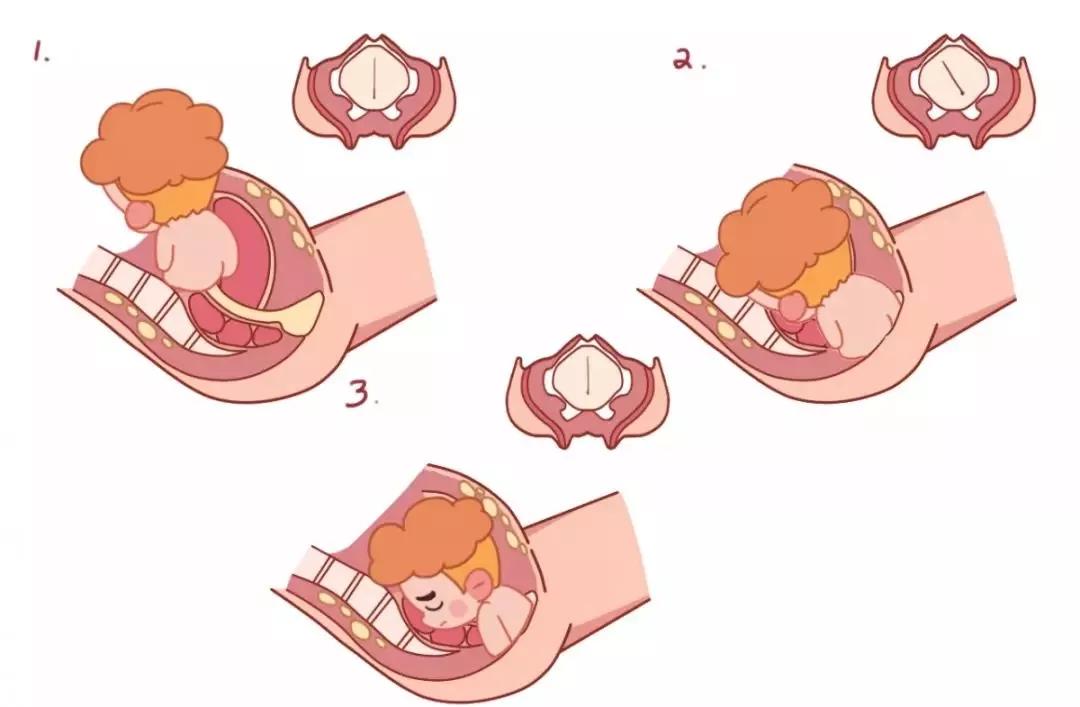 胎位中最常见的异常胎位,胎位朝上如何纠正胎位