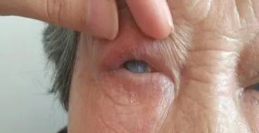 眼整形常见手术方式,眼整形美容手术