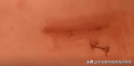 鏃犵棝鍒嗗ī瀵肩鏂,鎱у悍鏃犵棝鍒嗗ī鎵嬫湳