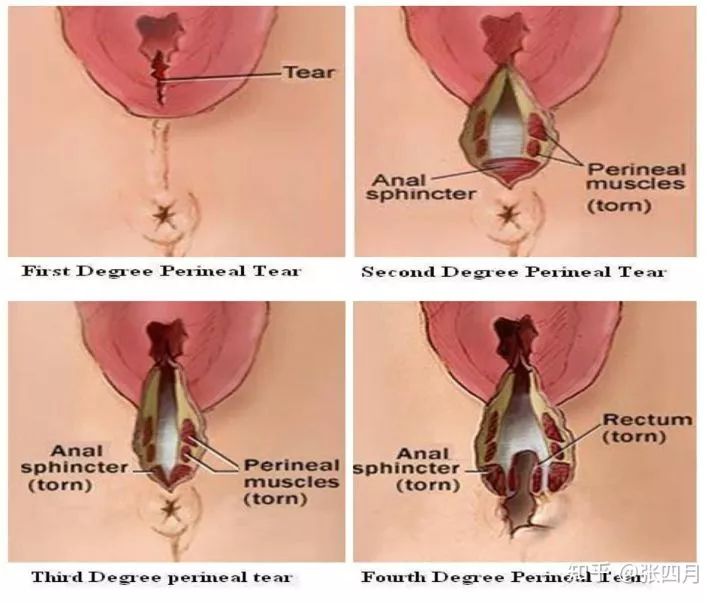 女人生孩子过程中,这个动作看似寻常,实则十分危险