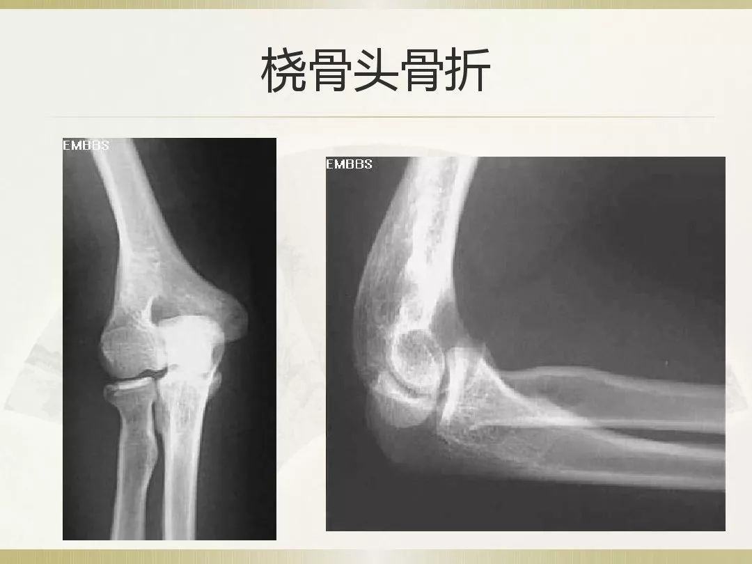骨科x光片读片技巧,放射科骨科读片教程