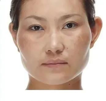 平颧骨女生怎样抗衰,颧骨在哪个位置最抗衰