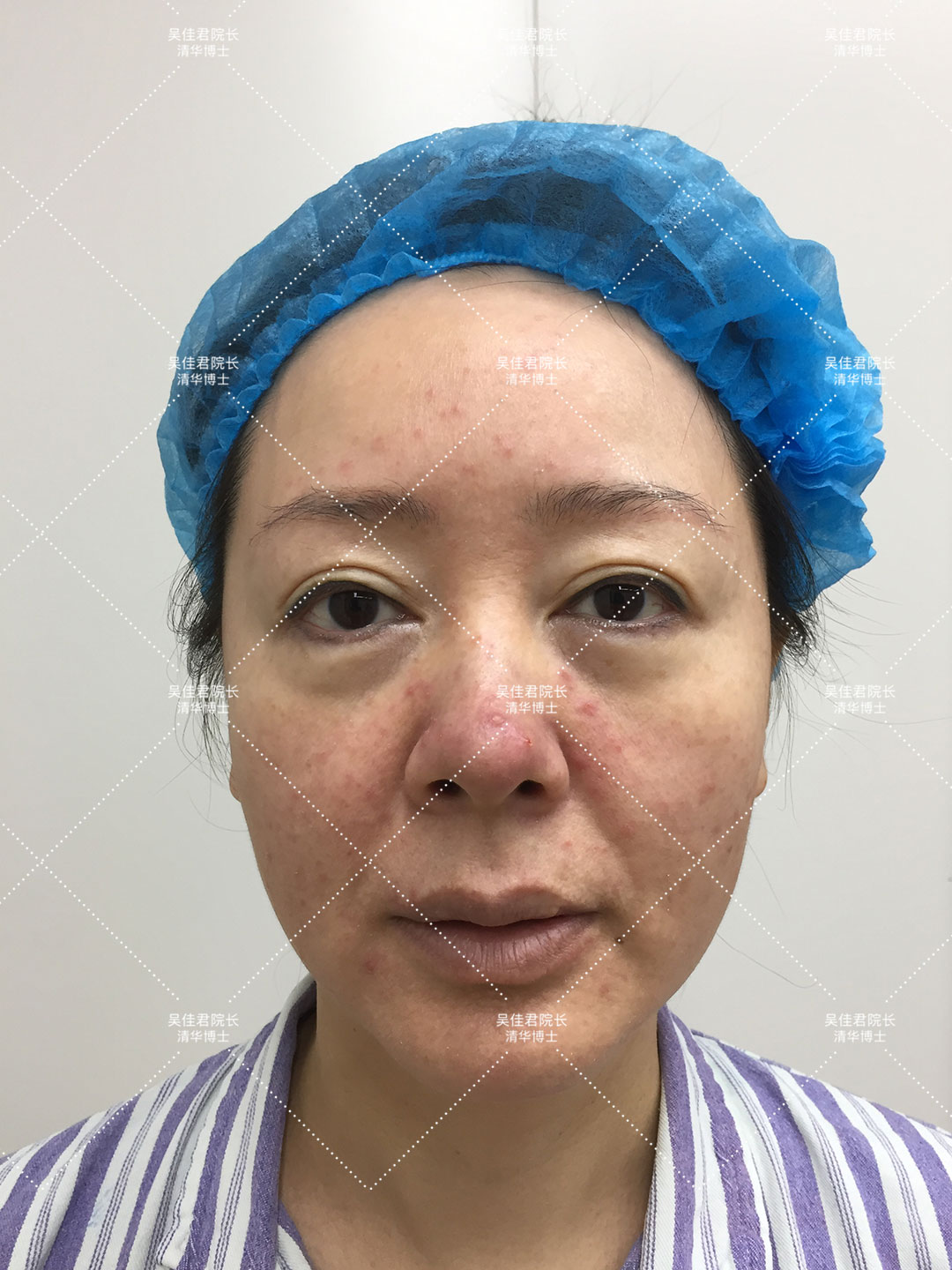 拉皮手术会加速衰老吗亲身经历,40多岁做小拉皮术后6个月