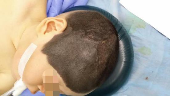 黑毛痣怎么治疗才不会留下疤痕,黑毛痣怎么治疗最有效