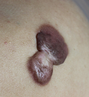 疤痕体质用什么方法祛疤好,欣奕除疤凝胶对疤痕体质有效果吗