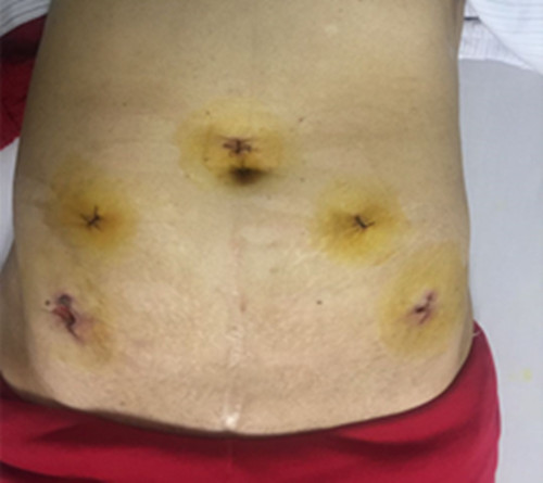 结肠恶性肿瘤去哪个医院最合适,结肠肿瘤巨大如何处理