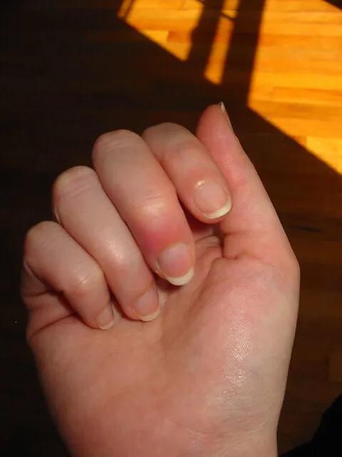 解决甲沟炎比较好的方法,甲沟炎很严重怎么修