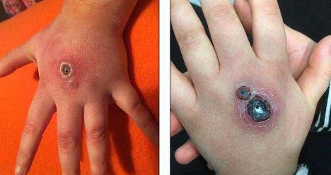 孩子被马蜂蛰妈妈笑了,孩子被马蜂蛰了擦什么药膏