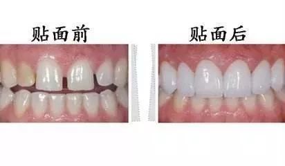 儿童牙齿变黄怎么美白,牙齿为什么会变黑该怎么改善