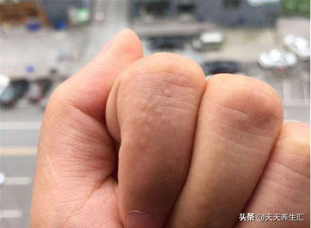 手上长水泡挠破了怎么办,手上起小水泡挠完了有点疼