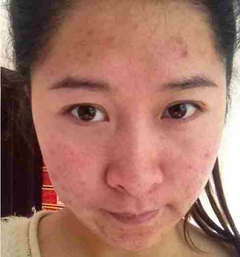 女生长痘痘是因为什么原因引起的,女生长痘痘是不是生理原因