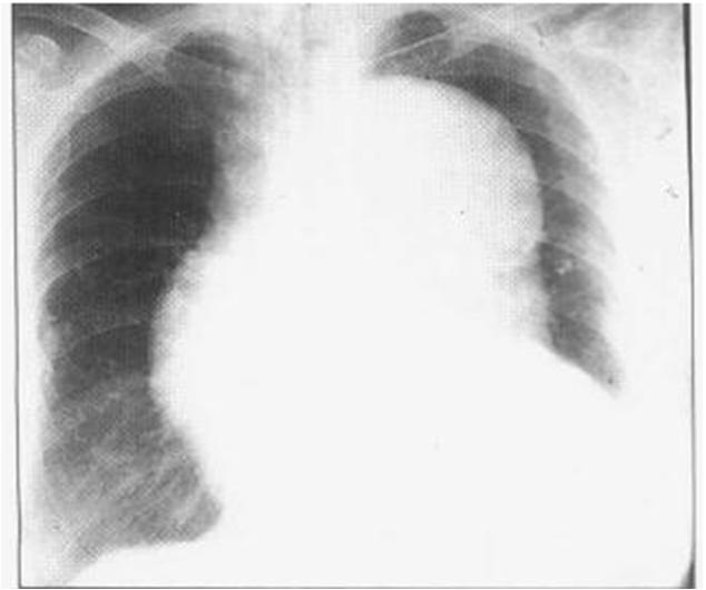 急性心肌梗死的做法,内科主治心肌梗死视频