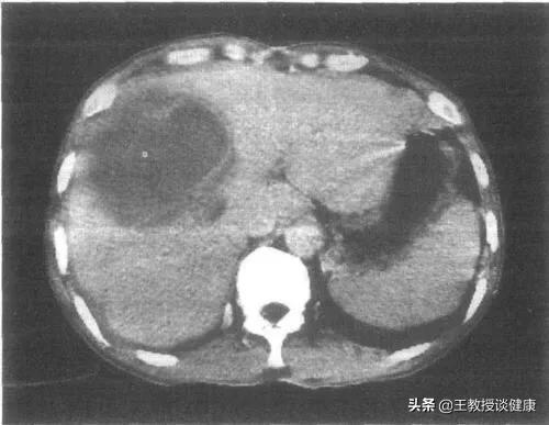 肛周脓肿是不是糖尿病引起的,脓肿为什么会有硬结
