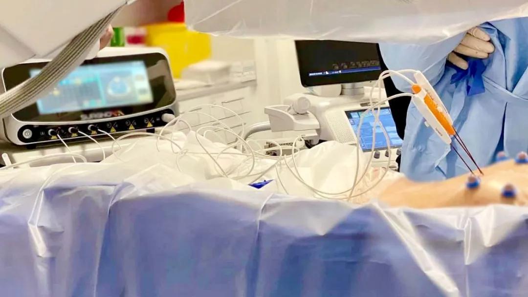 新一代不可逆电穿孔设备|赛诺微在欧洲完成首例IRE手术