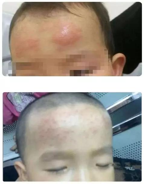 成年人发烧可以用儿童退热贴吗,发烧退热贴真的有用吗