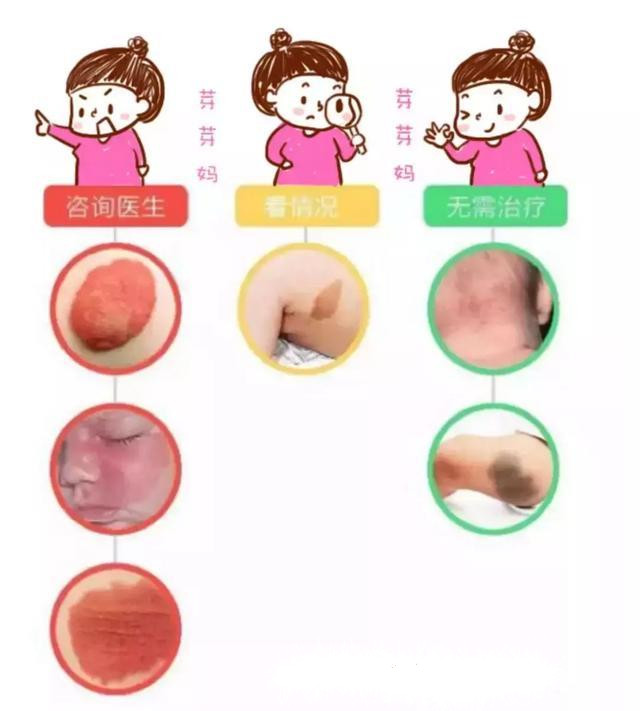 为什么宝宝出生屁股会有青胎记,宝宝出生屁股上有淤青是什么原因