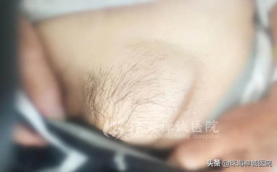 孩子疝气如何给他推回去,疝气复发要不要跟家里人说