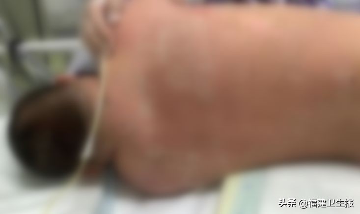 福建16岁少年发热出疹，一度昏迷！竟是患上这种传染病！早期症状像感冒，家长注意