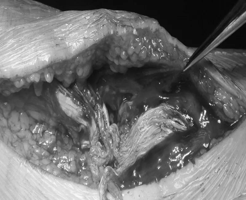 跟腱断裂术后康复训练,跟腱断裂恢复的小偏方