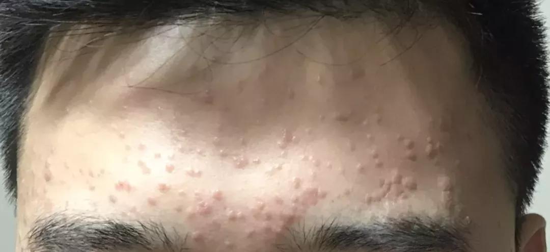 脸上长了像黑痣一样的东西,脸上长了像痘痘的东西是啥