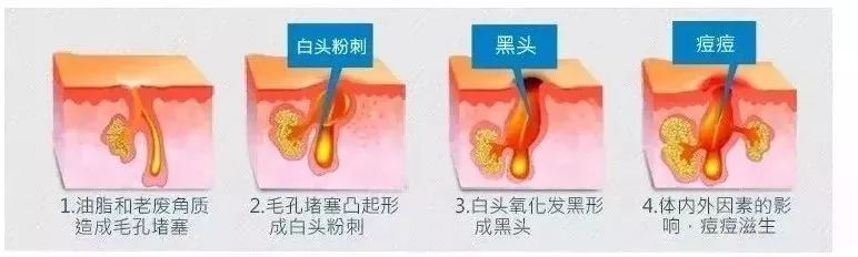 橘子皮怎么收缩毛孔,毛孔粗大橘子皮肤质还有救吗
