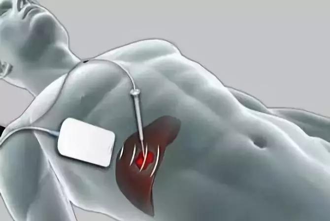 肿瘤介入治疗费用多少,走进肿瘤微创介入手术