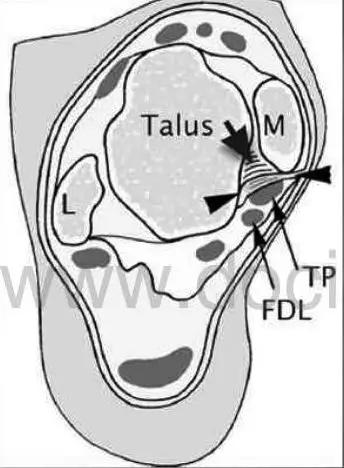 踝关节撞击症问诊,踝关节内侧撞击综合症位置图