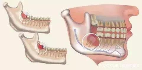 智齿冠周炎张口受限伴吞咽疼痛,智齿冠周炎一般疼痛多久