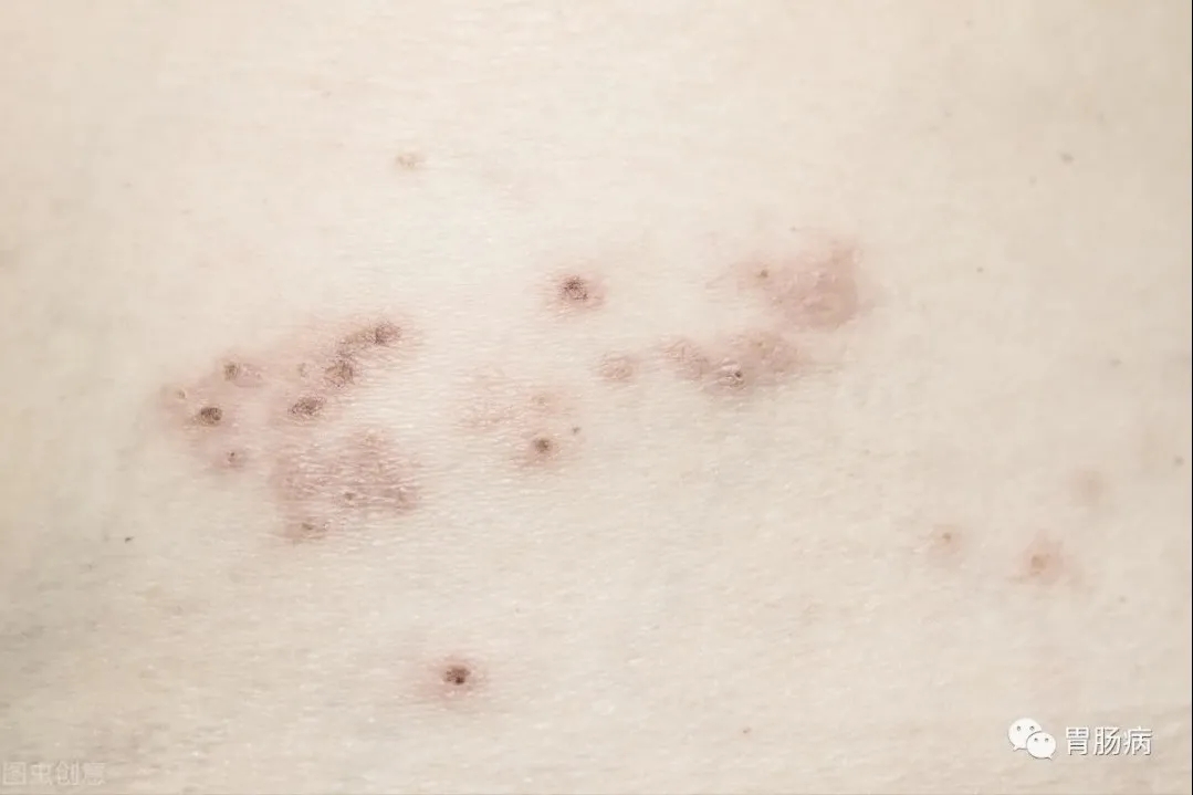 中山医院治带状疱疹,中山带状疱疹