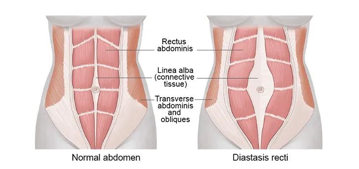 什么是腹直肌分离呀,什么是腹直肌修复视频