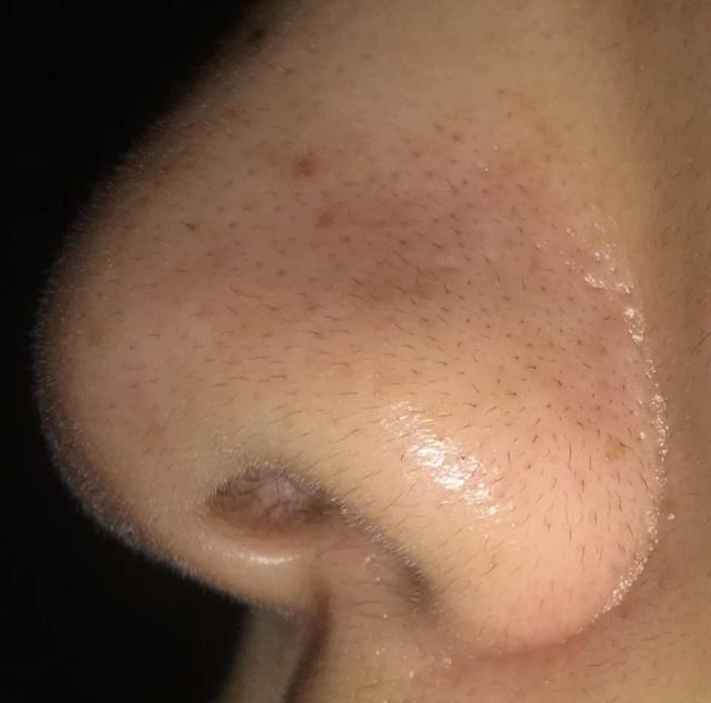 鼻子黑头毛孔粗大怎么去除,鼻子黑头严重毛孔粗大怎么办