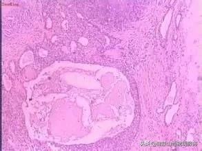 痒痒痒！「下面」还长了很多小疙瘩！医生，我是不是得了性病？