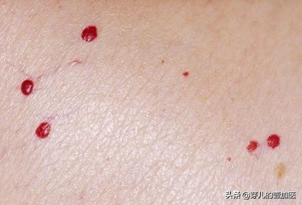 身上红色的痣可以用针扎破吗,胸前出现小红点血痣破了一直流血