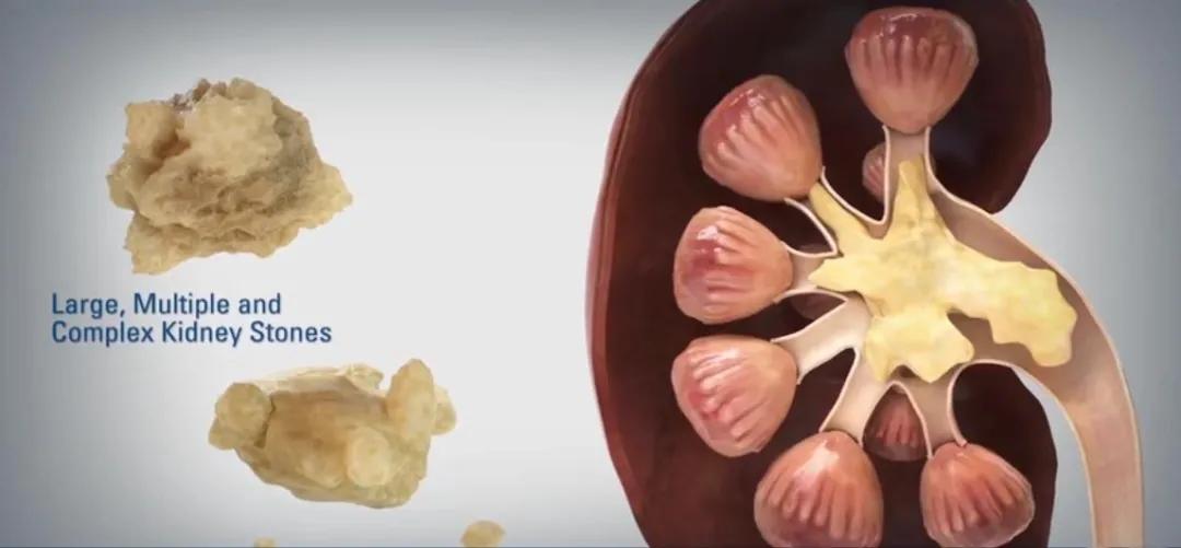 肾内结石过大怎么办,阜新治疗输尿管结石