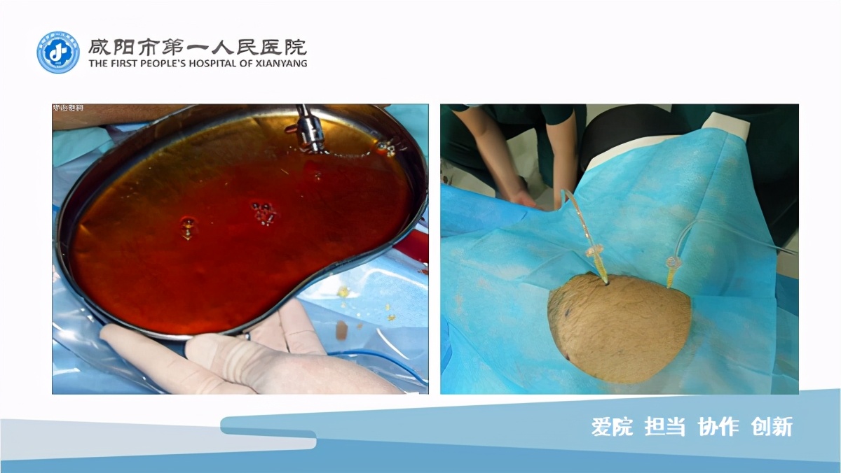 臭氧玻璃酸钠治疗膝关节炎怎么样,膝关节滑膜炎臭氧