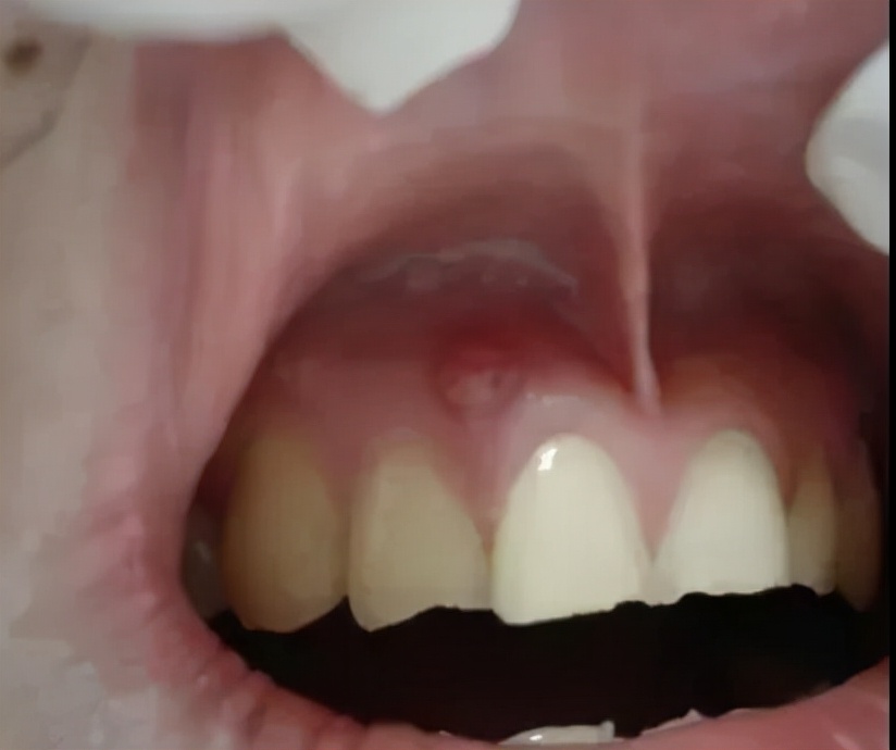 牙龈脓包挤出来几天又有脓咋办,牙龈上的小白色脓包为什么会反复