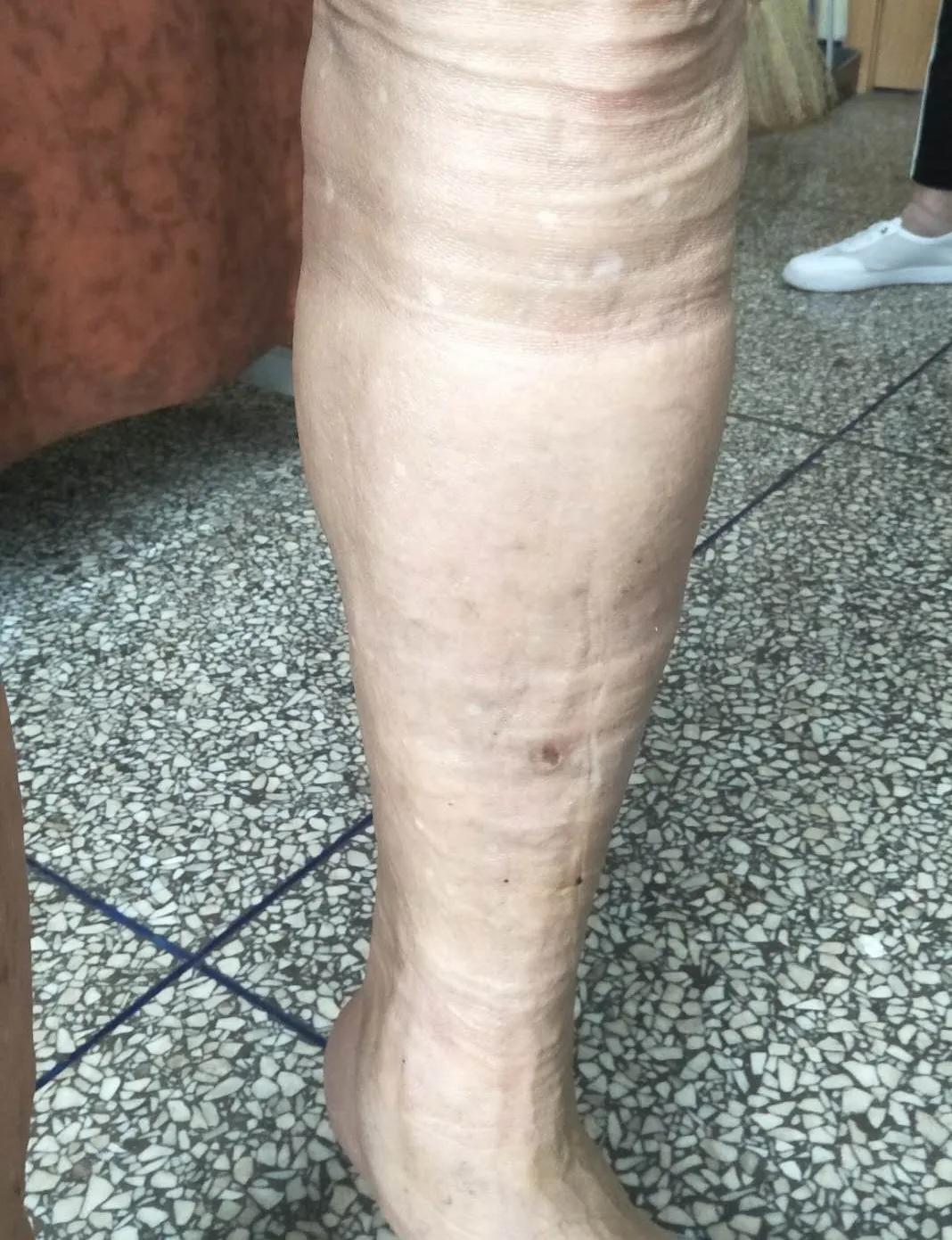 河北静脉曲张微创手术,邢台静脉曲张手术多长时间治好