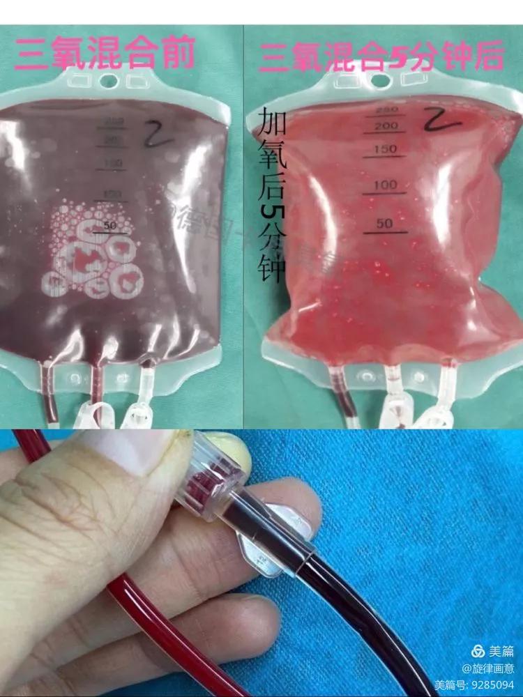 三氧自体血疗法病例,青岛哪家医院能做三氧自体血疗法