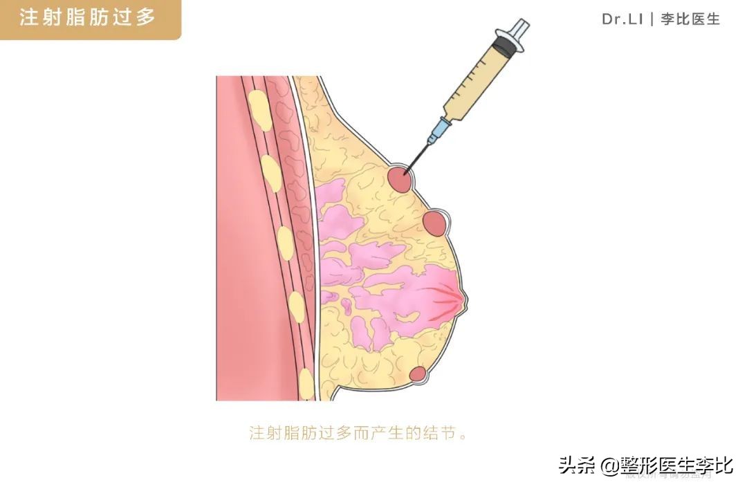 隆胸半年之后胸部有囊肿正常吗,脂肪隆胸以后胸部周围有小疙瘩
